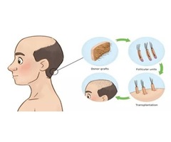 London hair transplant | free-classifieds.co.uk - 1