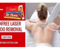 Beyond Tattoos | Painfree Laser Tattoo Removal With Dr. Numb | free-classifieds.co.uk - 1