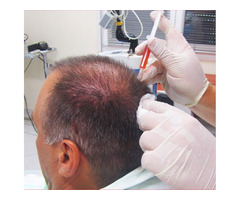 Get New Look with Perfectly Hair Transplant in the UK - 1