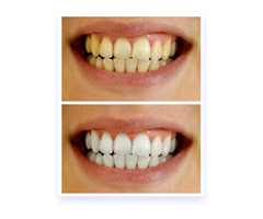 Natural Teeth Whitening: Everything You Need To Know  | free-classifieds.co.uk - 2