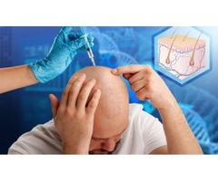 Safe and Fast Hair Transplant Treatment in the UK - 3