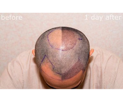 Safe and Fast Hair Transplant Treatment in the UK - 4