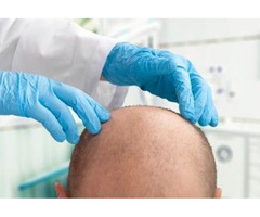 Safe and Fast Hair Transplant Treatment in the UK - 5