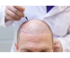 Change Your Look with Hair Transplant Solution in the UK | free-classifieds.co.uk - 1