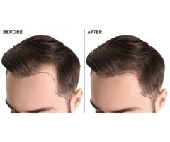 Change Your Look with Hair Transplant Solution in the UK - 2