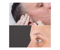 Beard Transplants and Eyebrow Transplants for Men and Women | free-classifieds.co.uk - 1