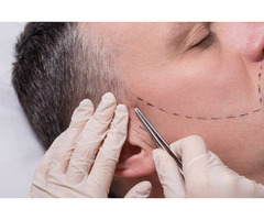 Beard Transplants and Eyebrow Transplants for Men and Women | free-classifieds.co.uk - 2