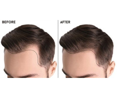 Best Hair Transplant Clinic in UK | Want Hair