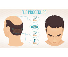 Best Hair Transplant Clinic in London, UK | Want Hair | free-classifieds.co.uk - 2