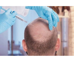 Best Hair Transplant Clinic in UK | Want Hair - 2