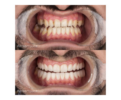 Best Dental Implant Surgery in UK | Want Smile | free-classifieds.co.uk - 1