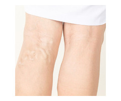 WHAT CAUSES VARICOSE VEINS? | free-classifieds.co.uk - 1