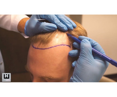 Achieve the Best Hair Transplant in the UK with Want Hair! | free-classifieds.co.uk - 3